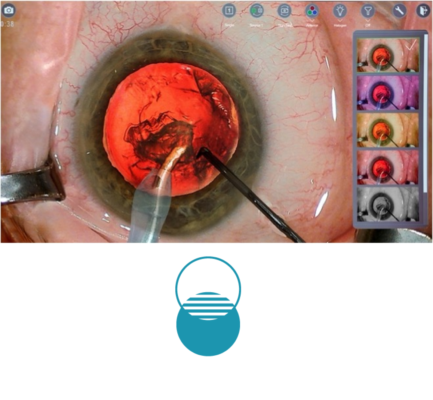 Een close-up van een oog tijdens een operatie, met chirurgische instrumenten op het scherm.  Miniaturen aan de rechterkant van het scherm tonen de verschillende kleurenfilters die beschikbaar zijn met het NGENUITY 3D Visualization System. Een blauw pictogram met twee cirkels die elkaar overlappen.
