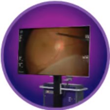NGENUITY 3D Visualization System monitor displaying a magnified surgical view used for real-time, immersive ophthalmic visualization
