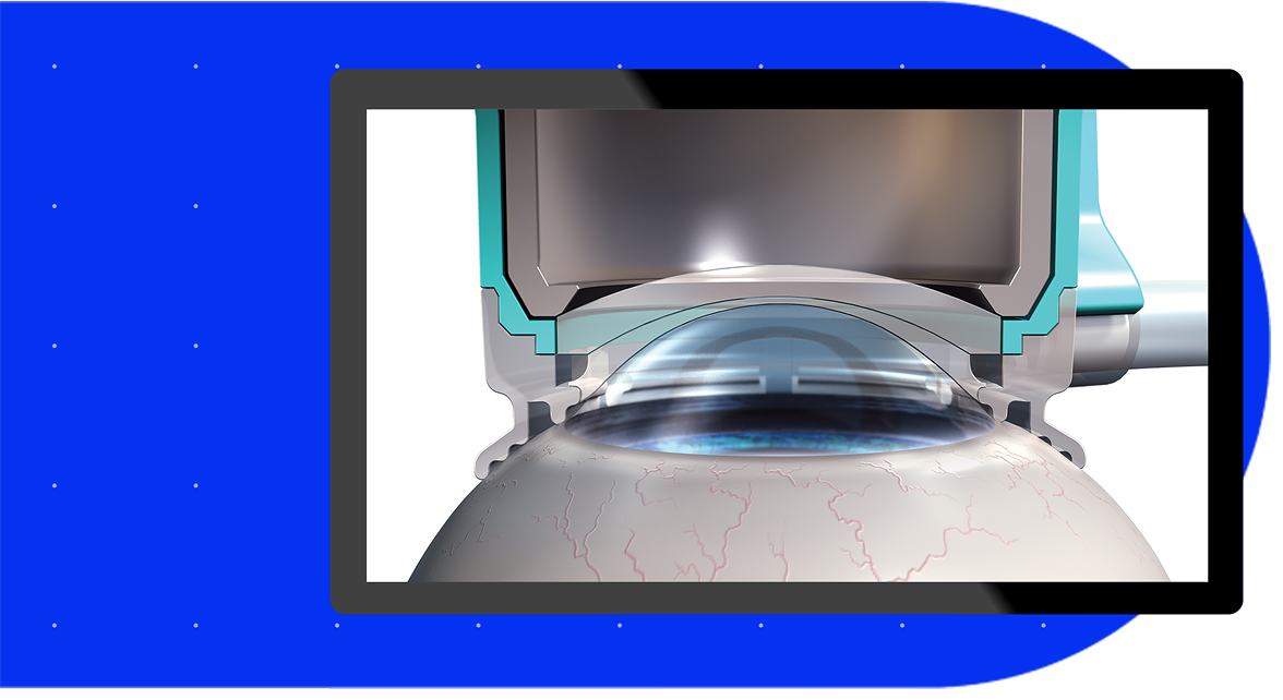 Illustration of a femtosecond laser system applying suction and alignment to the cornea during cataract surgery