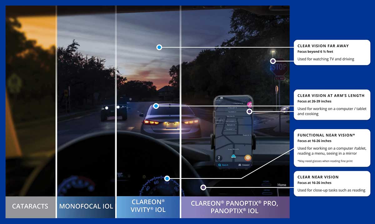 Nighttime comparison of cataracts, monofocal, Vivity, and PanOptix lenses showing clarity at distance, intermediate, and near vision.