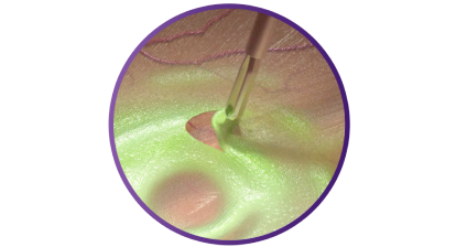 Close up of the SHARKSKIN ILM forceps grasping tissue to demonstrate its peeling ability.