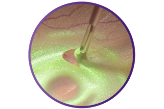 Close up of the SHARKSKIN ILM forceps grasping tissue to demonstrate its peeling ability.