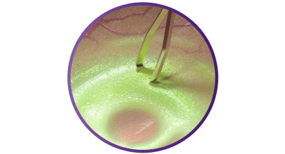 Close up of the SHARKSKIN ILM forceps touching ILM tissue.