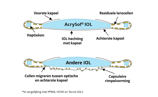 2 afbeeldingen. De eerste laat de AcrySof IOL zien die is gehecht aan het achterste kapsel zonder celmigratie. De tweede illustratie laat een andere IOL zien waarbij cellen migreren tussen het optische en posterieure kapsel.  