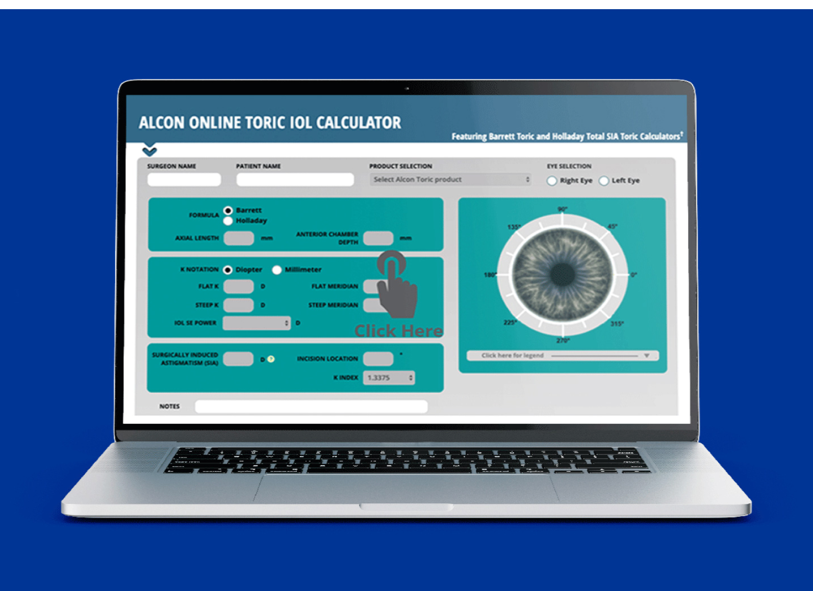 Open laptop met de Alcon Online Toric IOL Calculator op het scherm.  