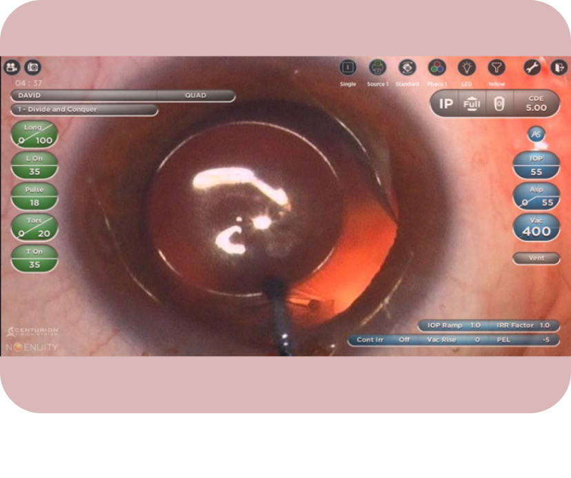 Een close-up afbeelding van een oog met een digitale overlay van NGENUITY met patiëntinformatie en chirurgische gegevens. 