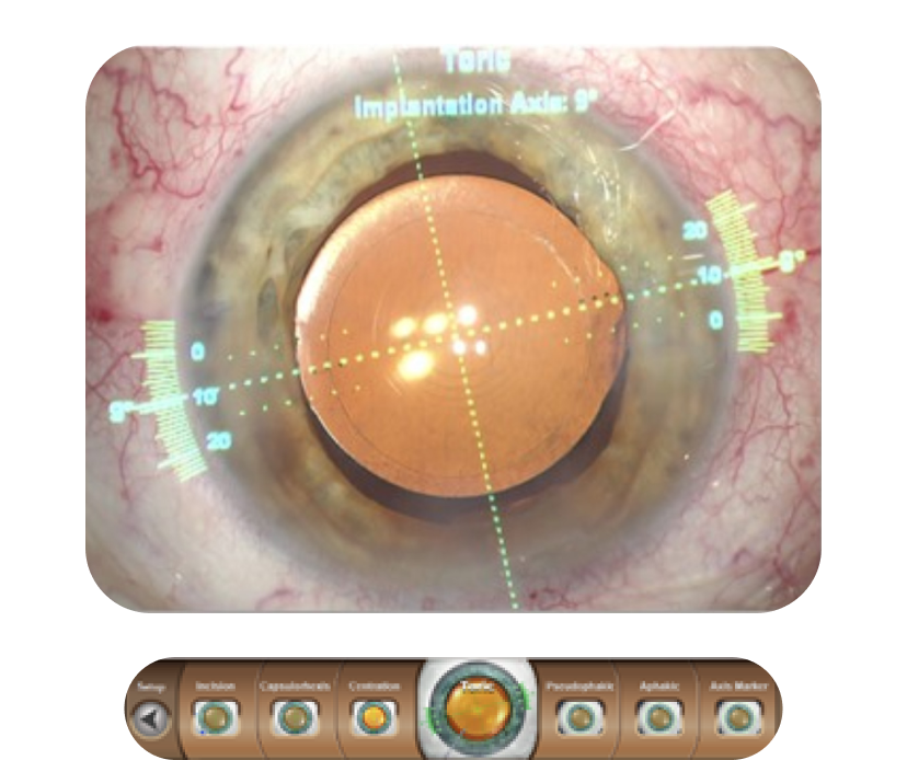 Een close-up afbeelding van een oog met een digitale overlay van VERION™ die de torische implantatie-as laat zien. 
