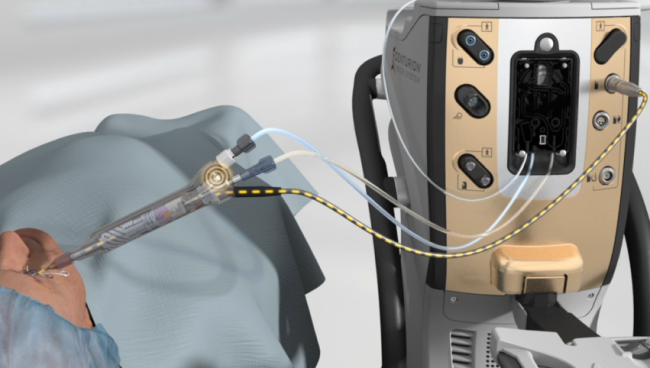 Een geanimeerde afbeelding van het CENTURION Vision System en het ACTIVE SENTRY handstuk naast een geopereerde patiënt. Een gele stippellijn markeert de irrigatiedruksensor in het ACTIVE SENTRY handstuk.  
