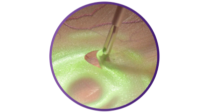 Close-up van de SHARKSKIN ILM Forceps die weefsel vastgrijpt om het pelvermogen te demonstreren.