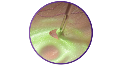 Close-up van de grijprand van de FINESSE SHARKSKIN ILM Forceps.