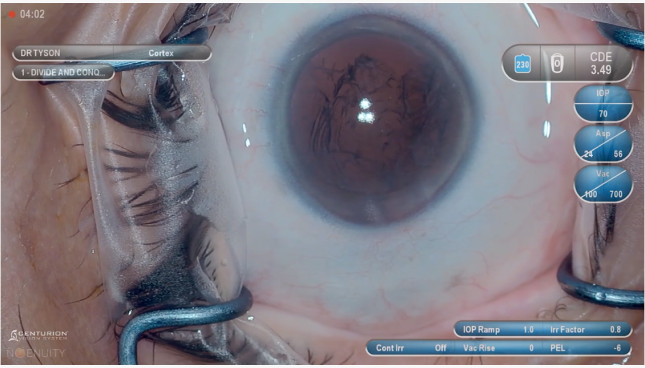 Een close-up van een oog dat tijdens een operatie wordt opengehouden met chirurgische instrumenten. Er is een digitale overlay op het beeld die de chirurgische parameters en instellingen toont.  