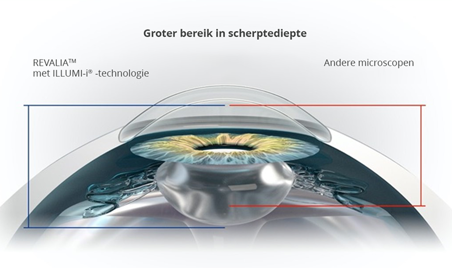 Een dwarsdoorsnede van een oog die de grotere focusdiepte met Revalia laat zien in vergelijking met andere microscopen. 
