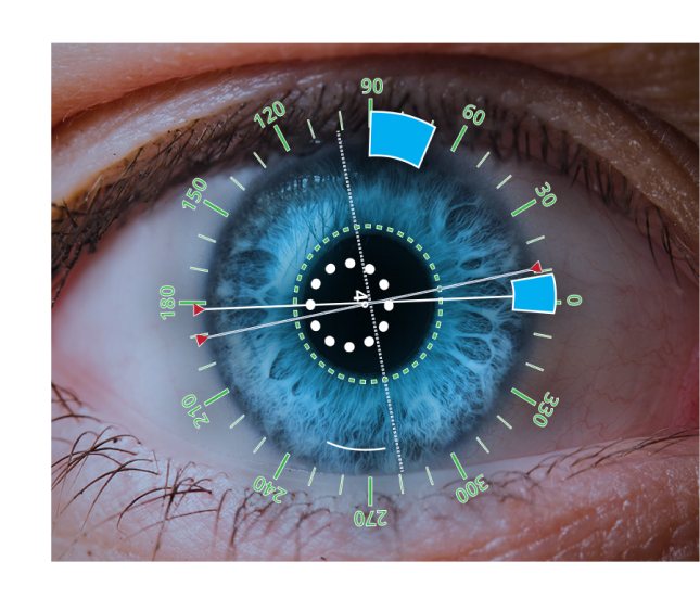 Een afbeelding van een oog van dichtbij met een digitale overlay die hoeken en snijlocaties toont.