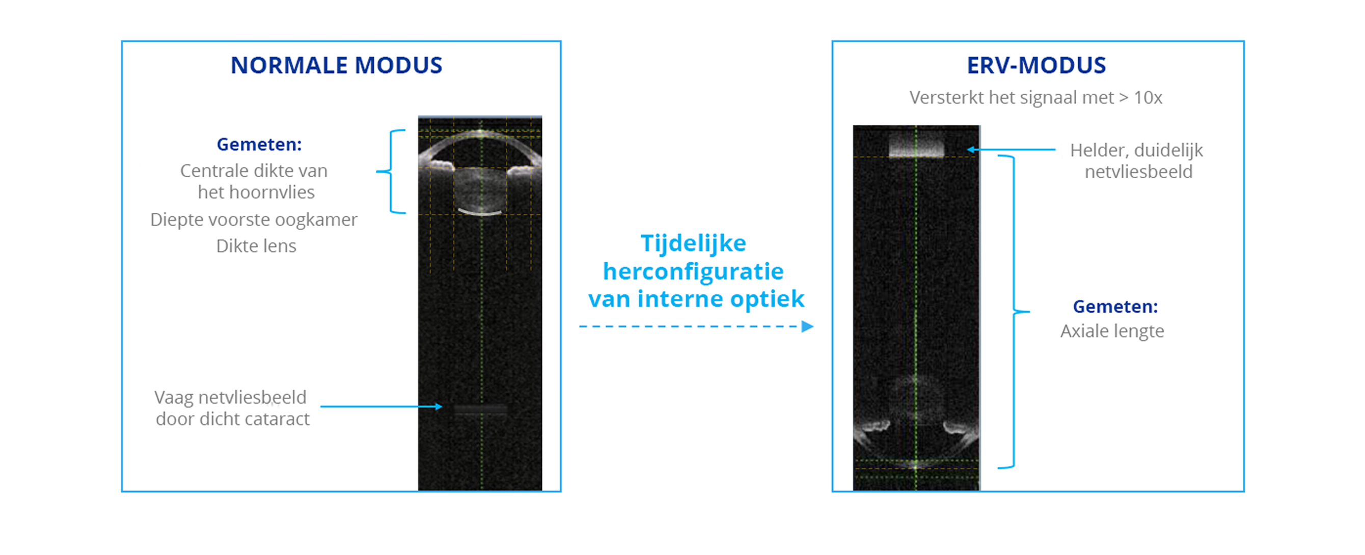 Een vergelijking van biometriemafbeeldingen vastgelegd door de ARGOS Biometer in normale modus en in de modus voor verbeterde netvliesvisualisatie (ERV). De ERV-modus herconfigureert de interne optiek om het signaal op het netvlies 10 keer te versterken in vergelijking met de normale modus.