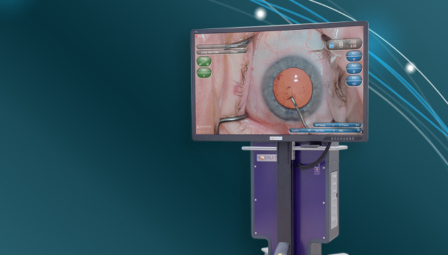 Een afbeelding van het NGENUITY 3D visualisatiesysteem met een monitor die een close-up van een oogoperatie weergeeft. Het apparaat verschijnt op een groenblauwe achtergrond. 
