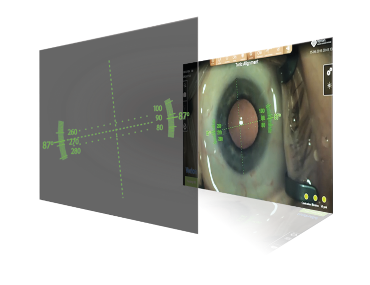 Een afbeelding van twee lagen die het oog en de gebruikersinterface tonen van hoe het oog wordt gemeten met de ARGOS Biometer.