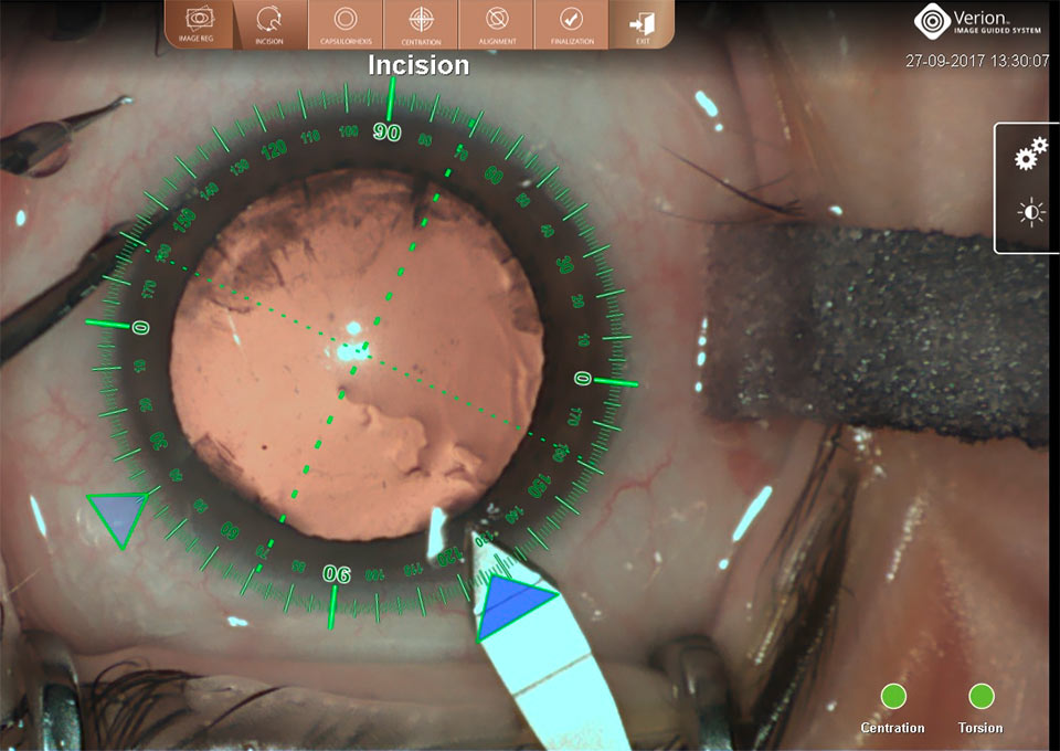 Nahaufnahme eines Auges während einer Kataraktoperation, gesteuert vom  VERION Bildgeführten System mit Anzeige von Inzisionsausrichtung und Orientierungsmarkierungen.
