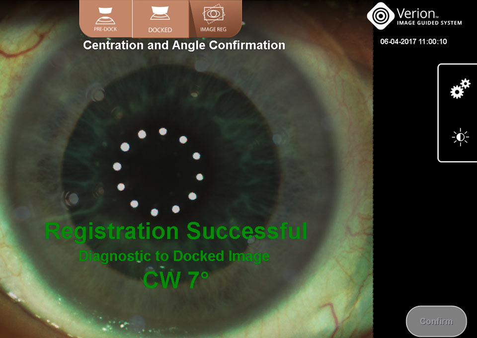 Nahaufnahme eines Auges mit dem  VERION Bildgeführten System, Anzeige der erfolgreichen Zentrierung und Winkelbestätigung mit abgeschlossener Registrierung.