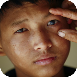 Крупный план мальчика с тёмными волосами, смотрящего прямо в камеру с серьёзным выражением лица. Рука осторожно оттягивает кожу под глазом, обнажая помутнение или поражение глаза.