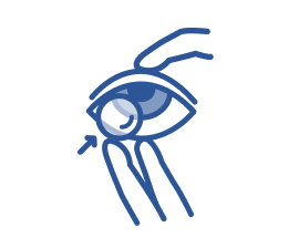Illustration of a contact lens being inserted into an eye, with arrows showing the lens being gently placed onto the eye’s surface